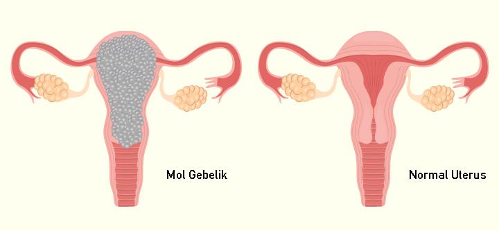 Molar-Pregnancy